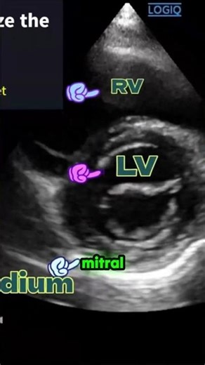 Fish Mouth Mitral Valve Explained 🔍 | Short-Axis Echo View (Must-Know Sign)