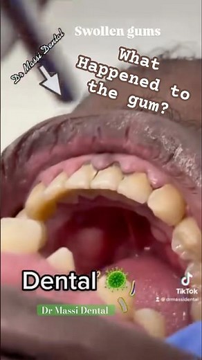 SWOLLEN GUM