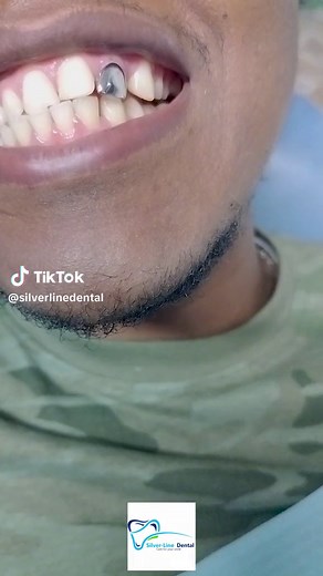 How Silver Teeth are Made: A Guide to Silver Tooth Caps