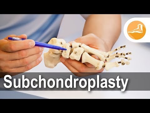 Foot & Ankle Subchondroplasty Procedure - Erik Nilssen, MD