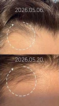 ❌No Filter❌ How My Husband Overcame a Receding Hairline🌱