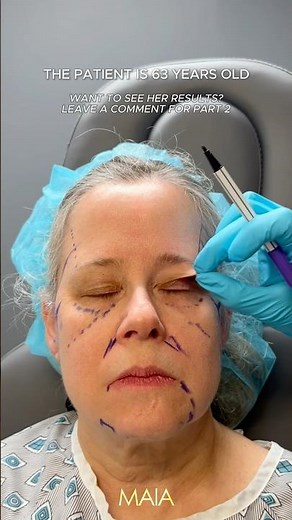 63 Year-Old’s Deep Plane Facelift Journey | Maia Plastic Surgery