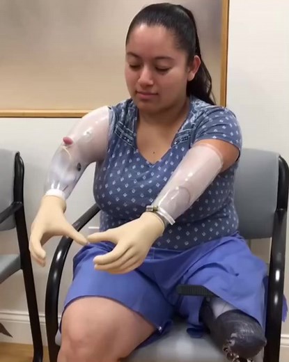 Linda was born with a congenital #limbdifference & this is her FIRST time ever using #prosthetics! #amputeelife #amputee #prostheticarms #bionics