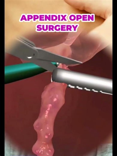 open appendixtomy short method