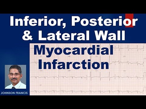 Inferior, Posterior and Lateral Wall Myocardial Infarction