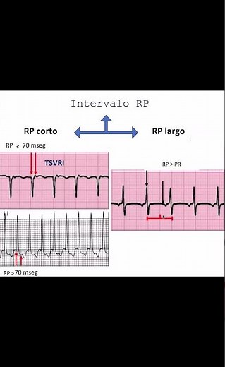 Cómo Identificar Tipos de Taquicardia en el Electrocardiograma. - Dr Jose Porto