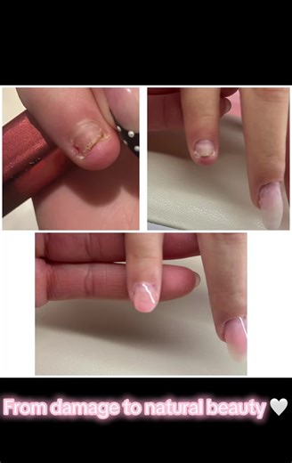 This nail was badly damaged few months ago and needed time to recover. We focused on strengthening and keeping everything natural while the nail grew back. No overbuilding, no pressure,just careful correction and a clean, healthy result. Next to it: a soft, natural baby boomer look, keeping the nails elegant and wearable. I truly believe beautiful nails start with respect for the natural nail. #brighton #worthing #biab #nail #gel