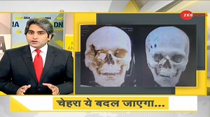 26K views · 547 reactions | #DNA: A bull butchered a man's eyes, nose and face; Doctors do wonders to his face suring surgery | Watch this report | Zee News English | Facebook