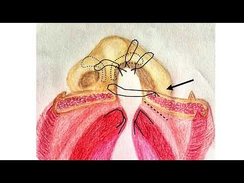 Primera cirugía de los niños con fisura labio-alveolo-palatina