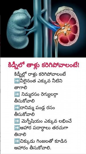 Natural Ways to Dissolve Kidney Stones