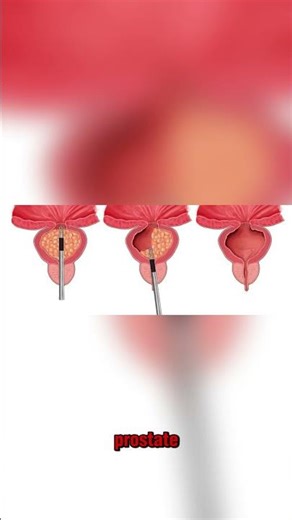 Transurethral resection of the prostate or T U R P