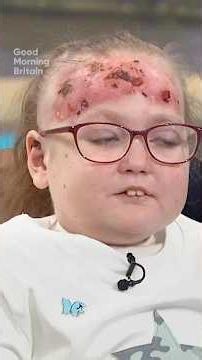 Jasmine has a rare condition called epidermolysis bullosa (EB), also known as "butterfly skin.