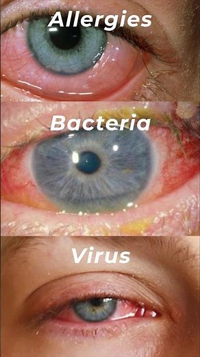 What's REALLY Causing Your Pink Eye (Conjunctivitis)?
