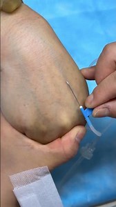 How to Give IV Injection Safely | Step-by-step Intravenous technique | perfectly IV & IM injection💉3