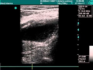 Popliteal Aneurysm In Doppler Exam • Video • MEDtube.net