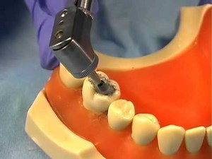 Amalgam Polishing