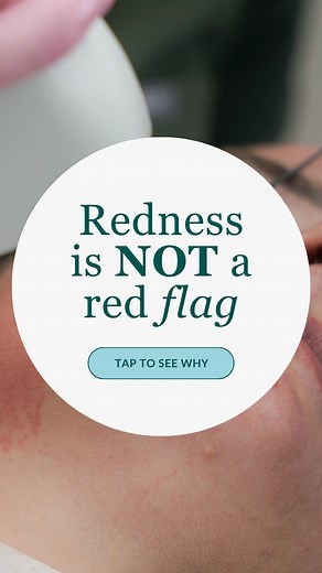 When you walk out of a non-ablative laser treatment with a little redness, it’s not a sign something’s wrong, it’s a sign your skin has begun the repair phase. This gentle heat works below the surface, encouraging collagen, smoothing texture, and supporting healthier skin structure over time. So if you’re in the chair and you see a bit of pink, take it as a quiet “it’s working.” The smoother, clearer, stronger skin you want begins with a consultation so we can assess your goals and guide you saf