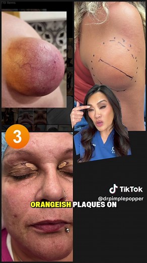 And the next NEW episode of Dr Pimple Popper Breaking Out on @LifetimeTV Mondays, 9/8c we have these three cases. Can you guess the diagnoses? 🤓 Watch this Monday and we will discuss later ☺️ #drpimplepopper #breakingout