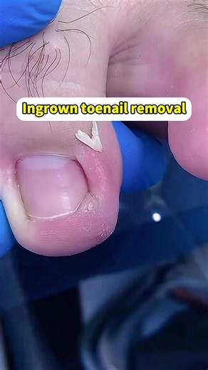 Treatment for an ingrown toenail #ingrowntoenail #ingrownnailremoval #podologia #pedicure #fyp