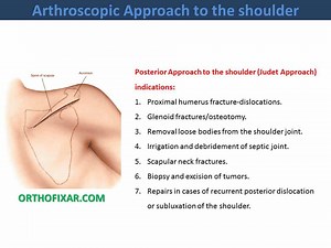 Posterior Approach To The Shoulder • Easy Tutorial • OrthoFixar 2026