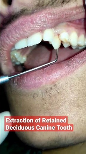 🇳🇵Extraction of Retained Deciduous Canine Tooth! Delayed Exfoliation! Bright Line Dental Care