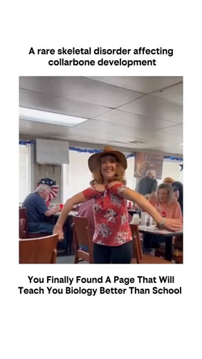 biology on Instagram: "🦴 Cleidocranial dysplasia (CCD) is a rare genetic disorder affecting bone development, characterized by absent or underdeveloped collarbones, delayed skull suture closure, and dental abnormalities. It impacts skeletal and dental growth, often requiring specialized management. #CleidocranialDysplasia #CCD #RareGeneticDisorder #GeneticCondition #BoneDevelopment SkeletalDisorder DentalAbnormalities MedicalAwareness RareDiseases HumanAnatomy OrthopedicCondition Genetics Healt