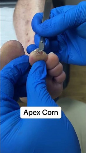 Say Goodbye to Corns: Top Foot Care Tips from an Expert Podiatrist #FootCare #CornRemoval