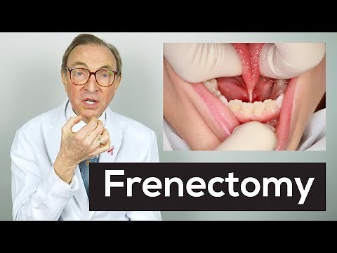 What is a Frenectomy?