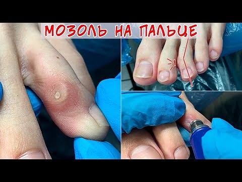 Removal of corns on the leg 🦶