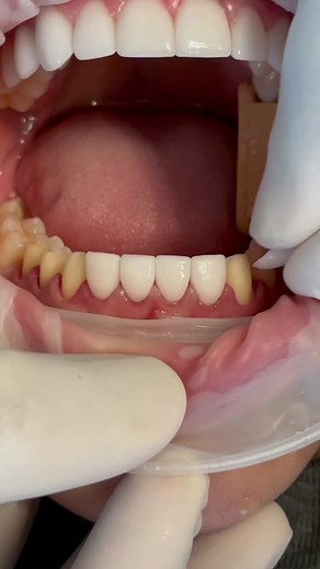 Tejas Patel, DDS (@drtejaspatel)’s videos with