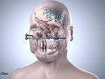 Animation show step-by-step process of face-transplant procedure