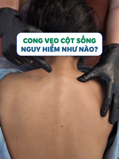 Vẹo cột sống ở người trẻ: Dấu hiệu, nguyên nhân và cách điều trị
