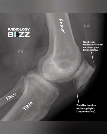 🦴Degenerative Enthesophytes in the Knee!