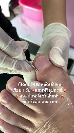 #ตัดเล็บขบคลองหก #ตัดเล็บขบรังสิต #ตัดเล็บขบวังน้อย #ตัดเล็บขบคลองหลวง #ตัดเล็บขบธัญบุรี #บริการตัดหนังขัดส้นเท้าครบวงจร