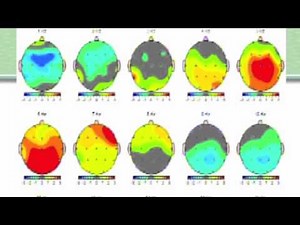 Becky Bingham: Brain maps, Part 2 The QEEG report