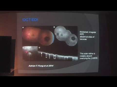 Congenital hypertrophy of the retinal pigment epithelium (CHRPE) by dr. Mohamed Medhat
