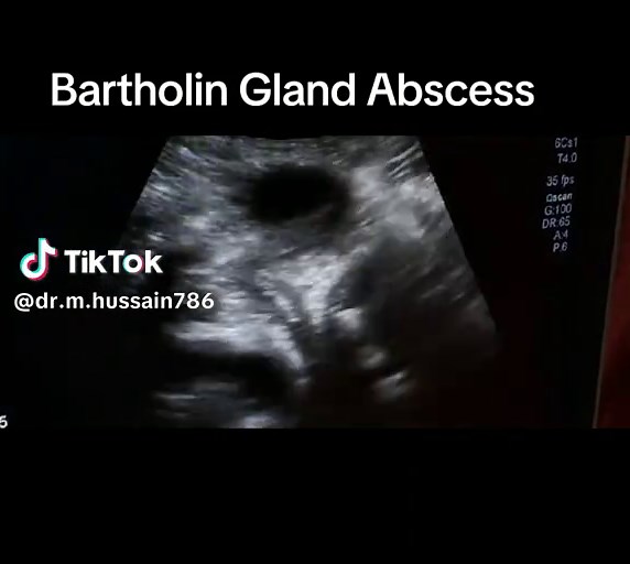 Understanding Bartholin Gland Abscess Symptoms