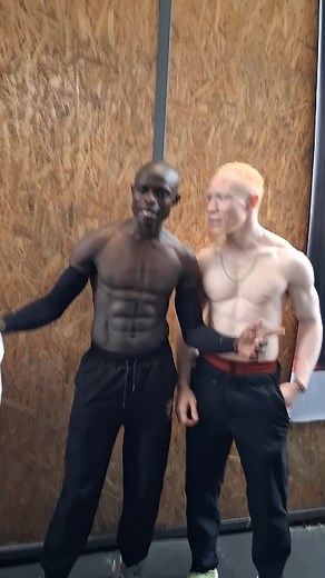 Albinism: Facts, Awareness and Support for International Albinism Day