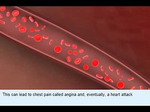 動脈粥樣硬化 (Atherosclerosis)