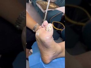 Plantar warts removal. That is hard to treat plantar wart. So many warts on the foot.