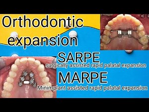 Orthodontic CHALLENGES with conventional Expansion,SARPE and MARPE