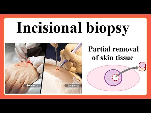 incisional biopsy