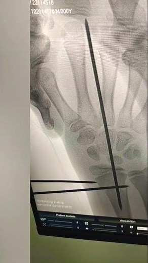 Kapandji Intrafocal pinning technique in paediatric distal metaphyseal radius fracture