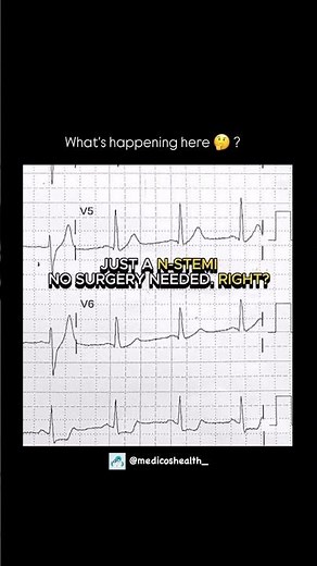 De Winter syndrome 🚨A STEMI equivalent #ECG #emergency