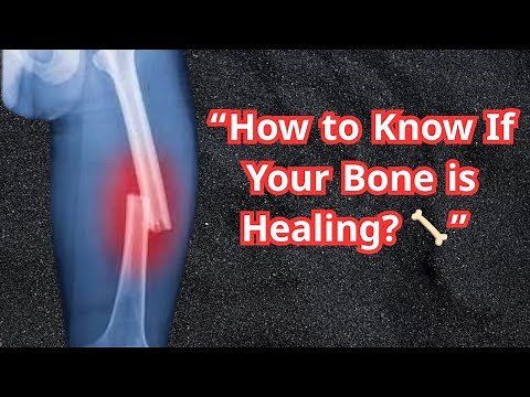 how bone fracture heal/How do you know if a fracture has healed or not?/ Signs of Fracture Healing