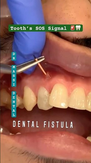 Dental Fistula: Your Tooth’s SOS Signal 🚨🦷