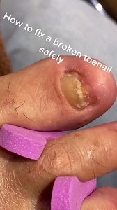 3.2K views · 64 reactions | How to fix a broken toenail? credit: theknailsbartx. #brokentoenail #acrylic #nailart #nailtech #nailtutorial #tutorials #acrylictutorial | Nail Studio | Facebook