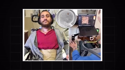 Neuralink Results Of First Human Trial!