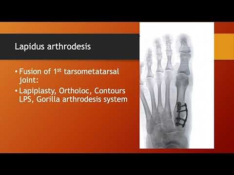 A comparison of current types of bunion surgery