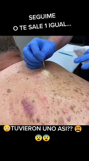 #pimpleremover #pimplepop #pimples #viral #deolane #asmr #espinhas #cravo #brasil